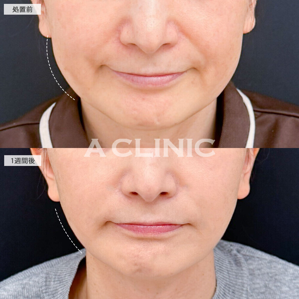A式美肌たるみ切開なら術後1週間で10歳若見え！こちら処置前と1週間後の症例です(50代女性)
