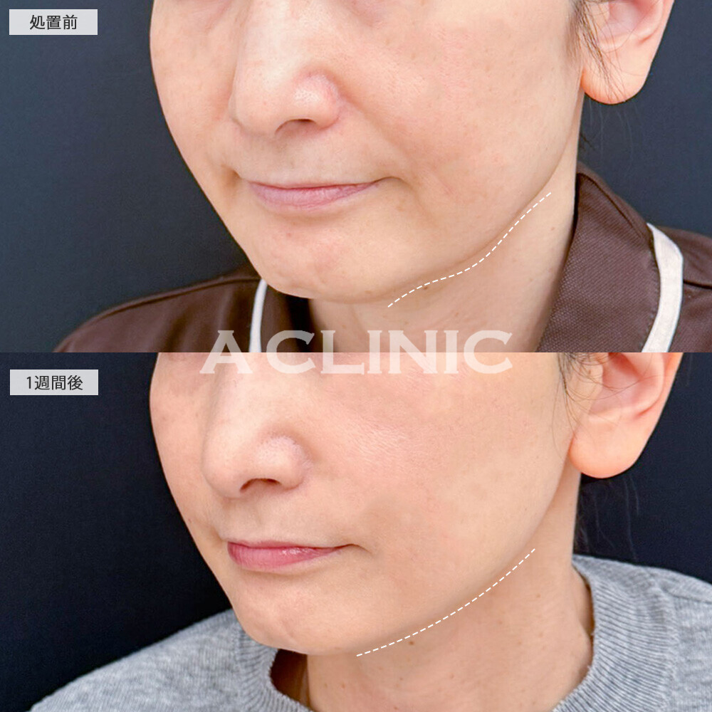 A式美肌たるみ切開なら術後1週間で10歳若見え！こちら処置前と1週間後の症例です(50代女性)