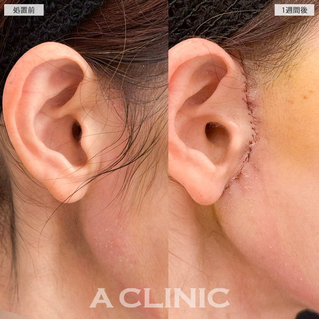 口横のたるみやほうれい線が改善されて若返りました！A式美肌たるみ切開の処置前と1週間後の症例です(50代女性)