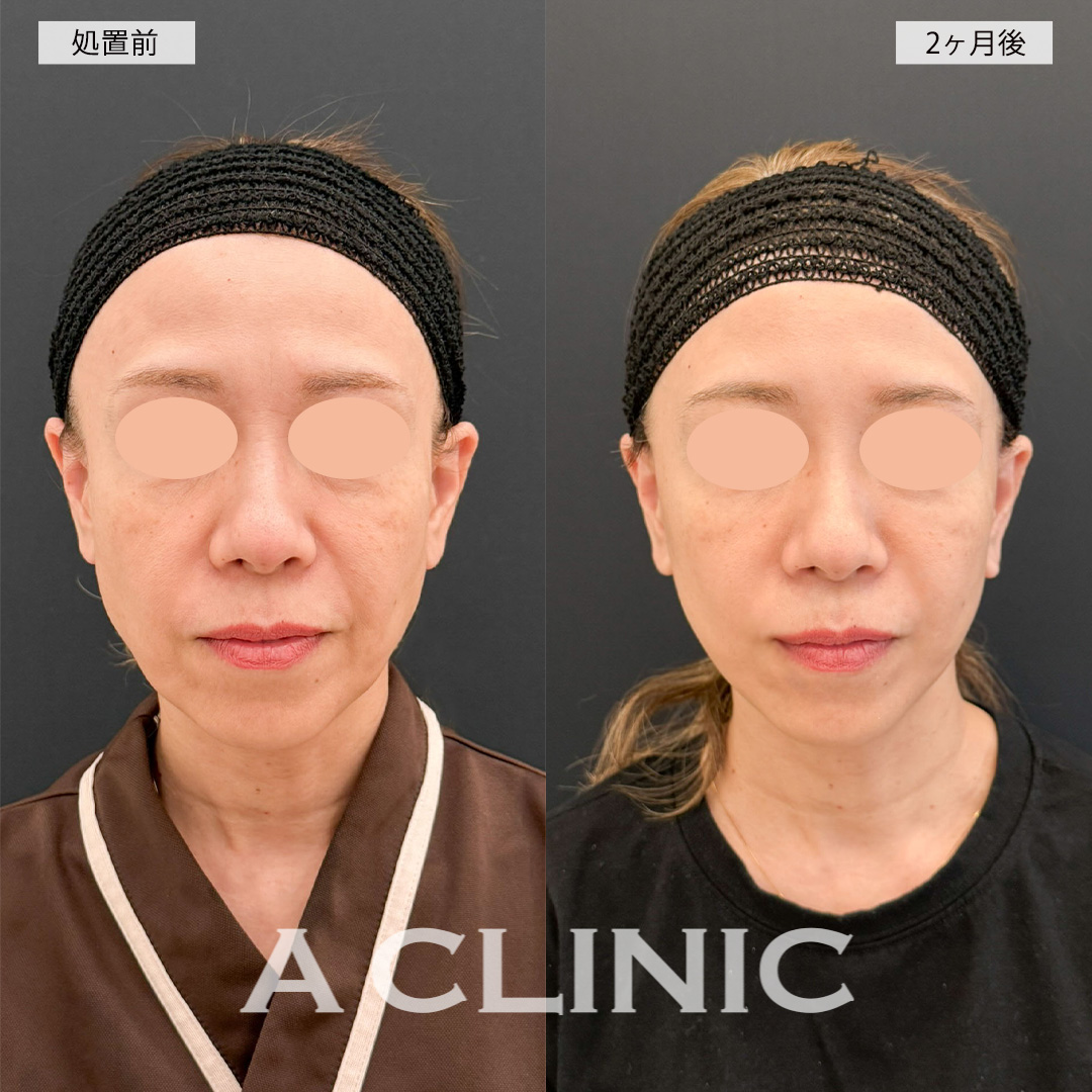 A式美肌たるみ切開で口元のシワが薄くなり若返った印象に！こちら処置前と2ヶ月後の症例です(50代女性)