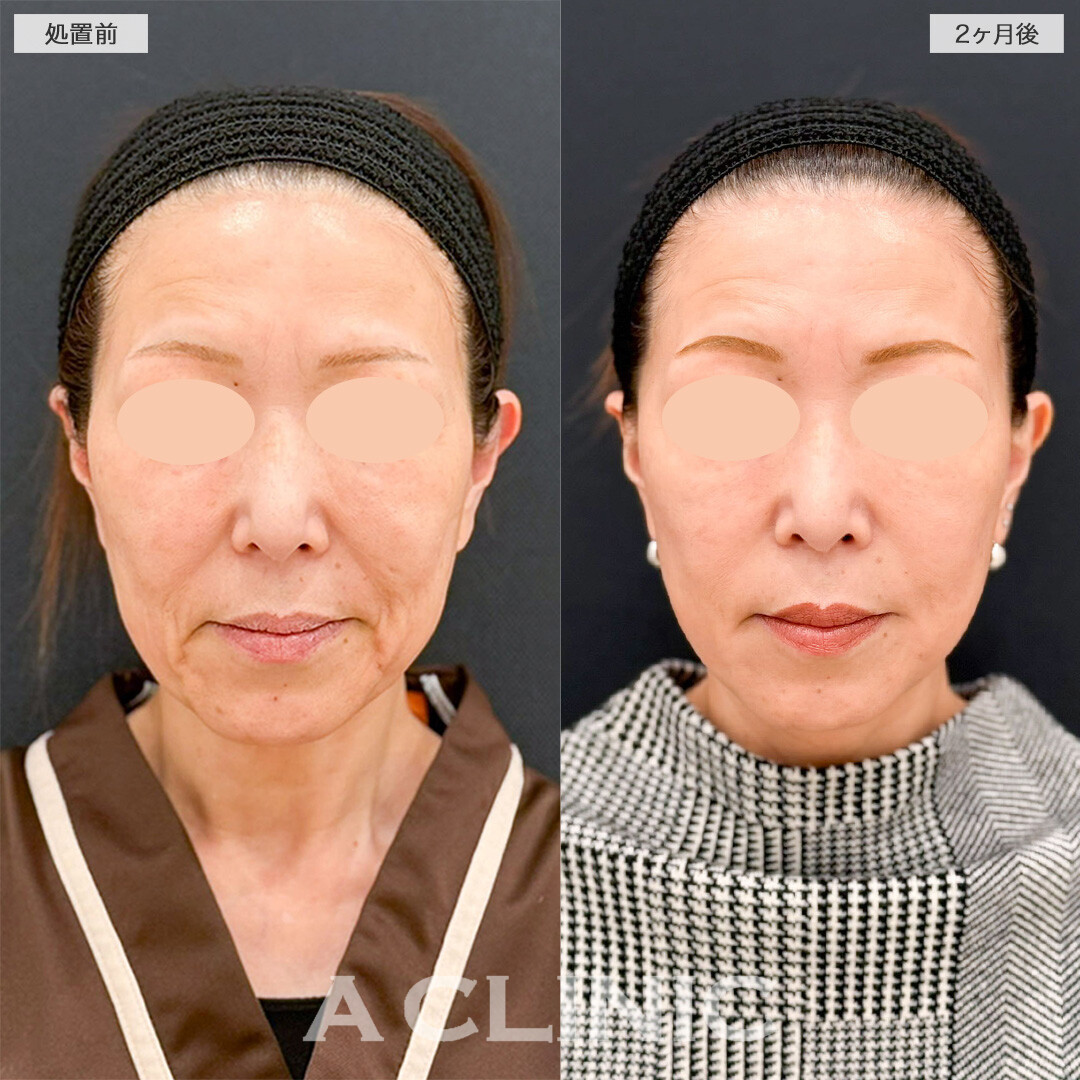 A式美肌たるみ切開で口元のたるみが改善し若返りに成功しました！こちら処置前と2ヶ月後の症例です(50代女性)