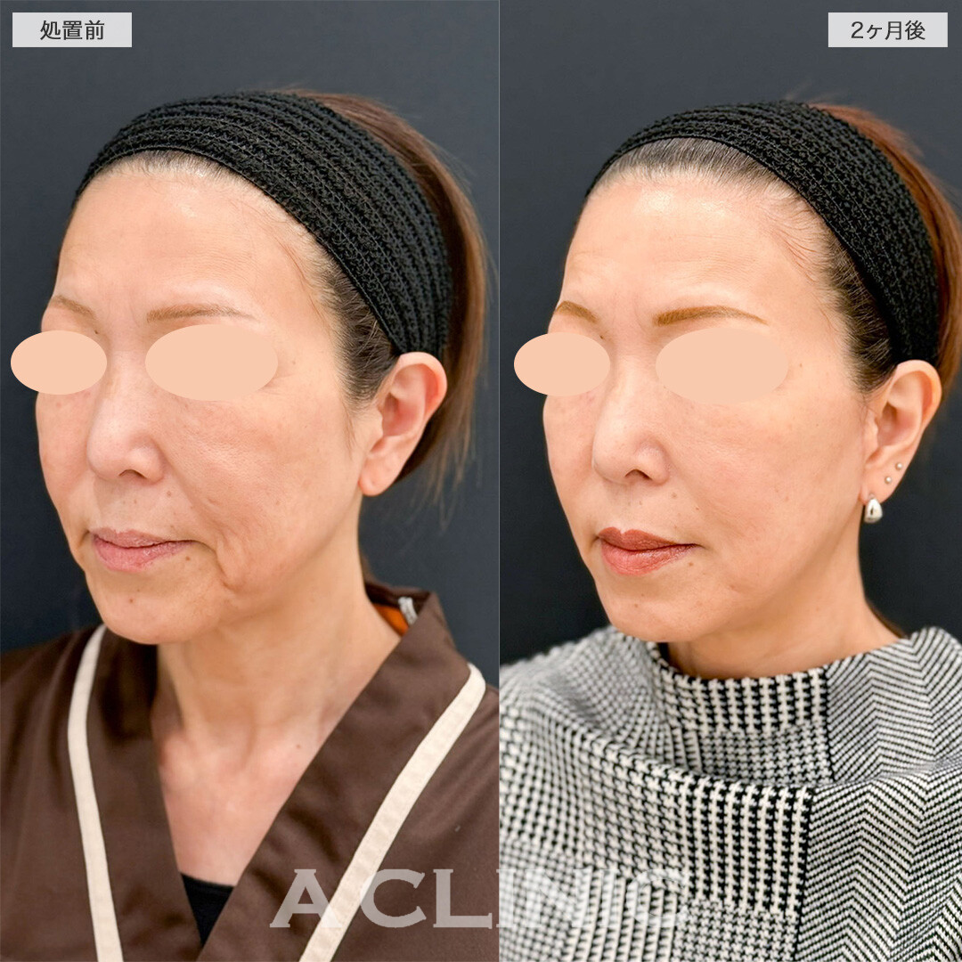 A式美肌たるみ切開で口元のたるみが改善し若返りに成功しました！こちら処置前と2ヶ月後の症例です(50代女性)