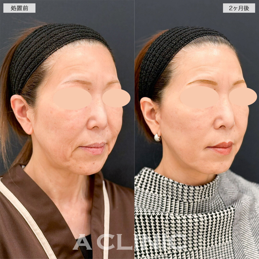 A式美肌たるみ切開で口元のたるみが改善し若返りに成功しました！こちら処置前と2ヶ月後の症例です(50代女性)