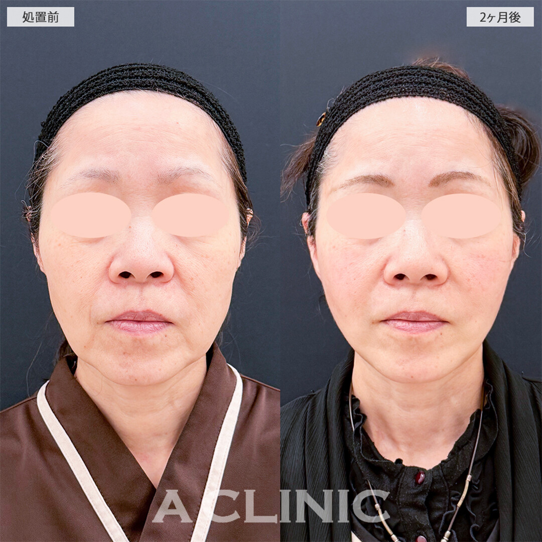 A式美肌たるみ切開と1day小顔脂肪吸引の組み合わせはたるみを一撃で減らせます！こちら処置前と2ヶ月後の症例です(50代女性)