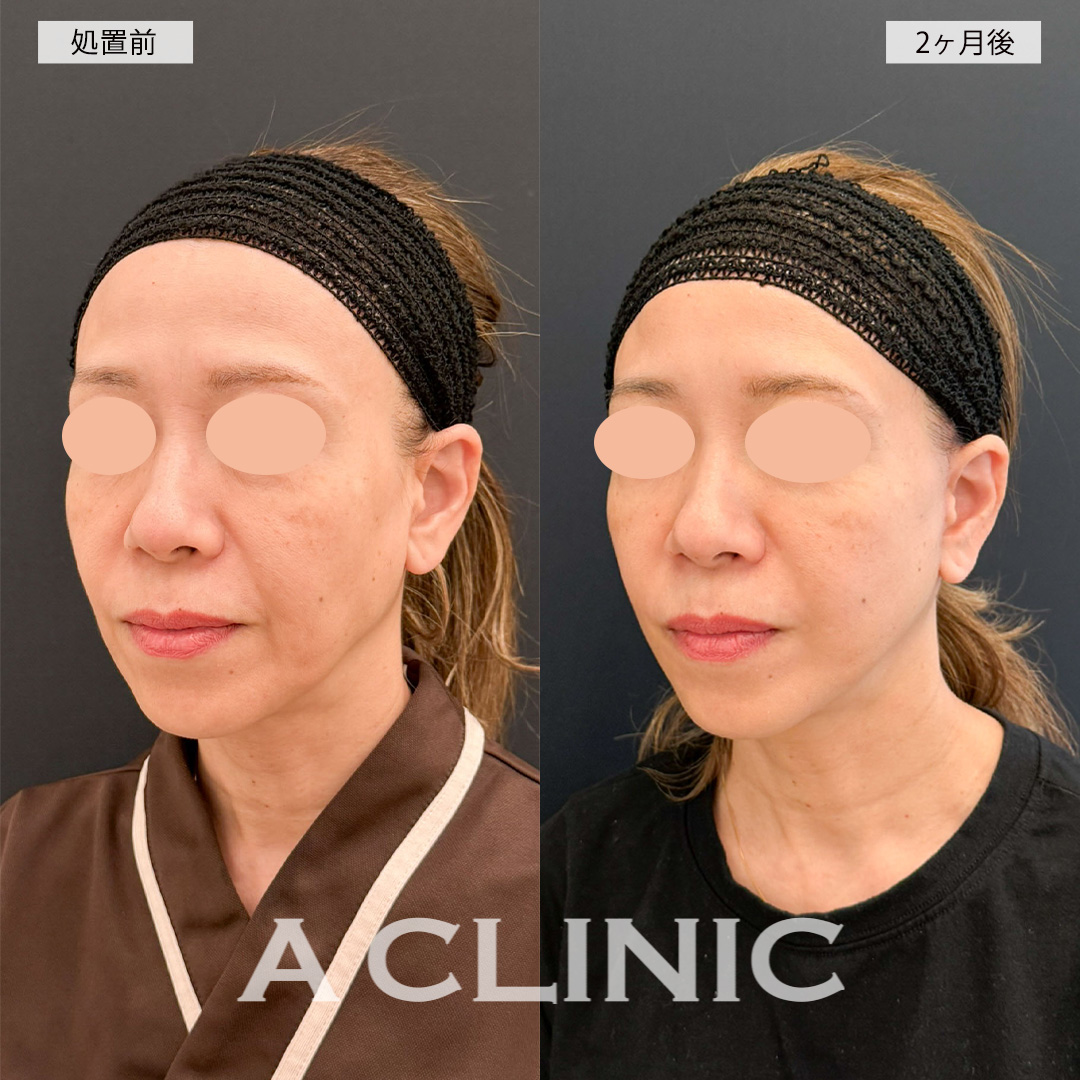 A式美肌たるみ切開で口元のシワが薄くなり若返った印象に！こちら処置前と2ヶ月後の症例です(50代女性)