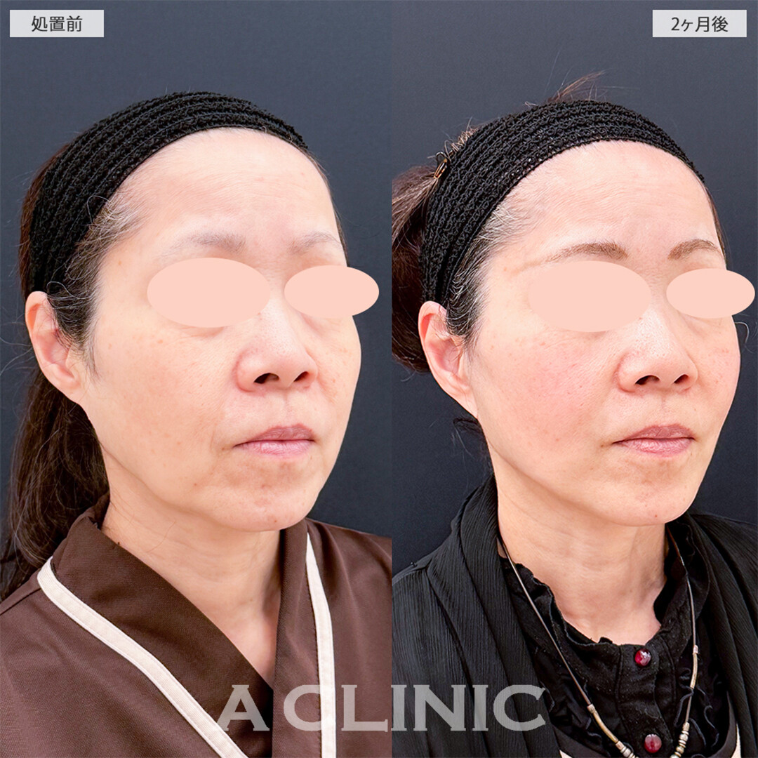 A式美肌たるみ切開と1day小顔脂肪吸引の組み合わせはたるみを一撃で減らせます！こちら処置前と2ヶ月後の症例です(50代女性)
