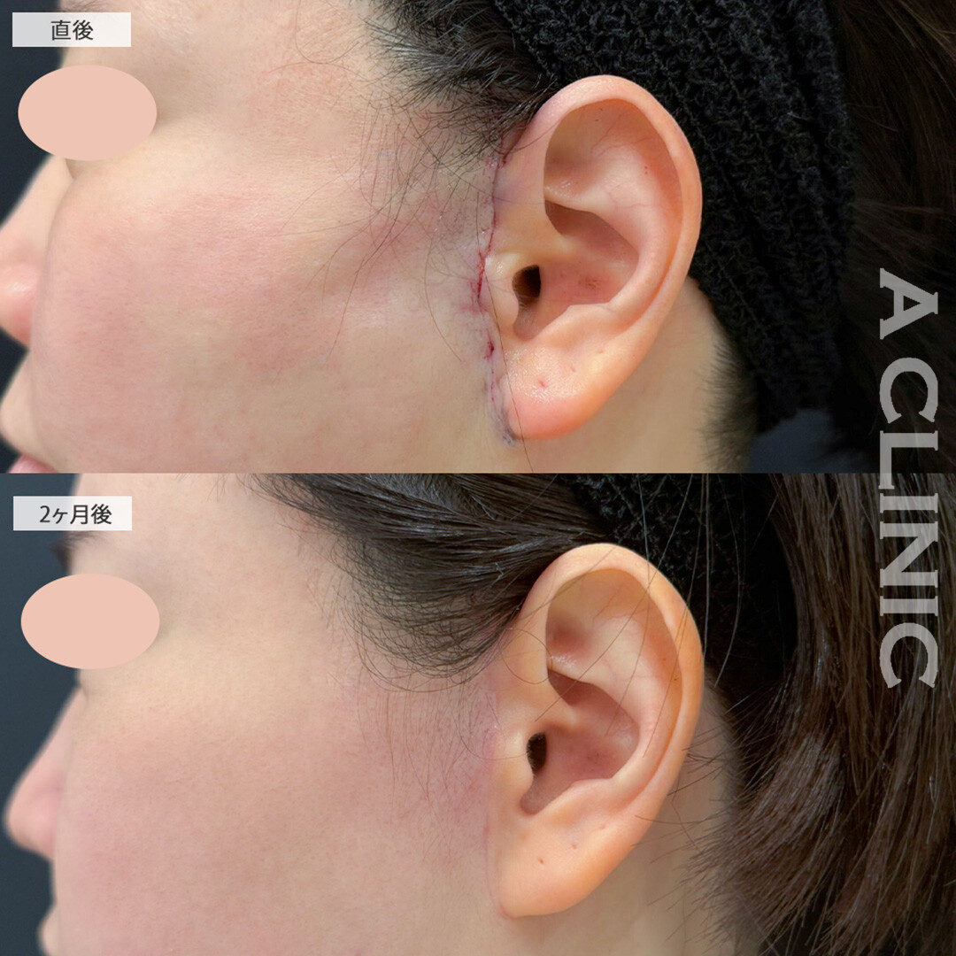 【直後の傷跡あり】A式美肌たるみ切開と小顔エラボトックスで気になるたるみを改善しフェイスラインがスッキリしました！こちら処置前と2ヶ月後の症例です(40代女性)