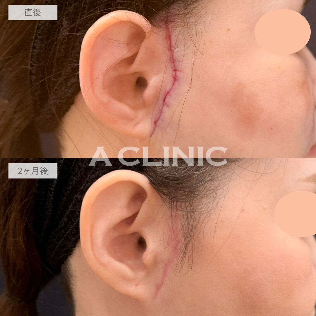 【直後の傷跡あり】A式ナゾラリフトでたるみを解消しつつ引きあげすぎずに自然で上品な印象に！こちら処置前と2ヶ月後の症例です(50代女性)