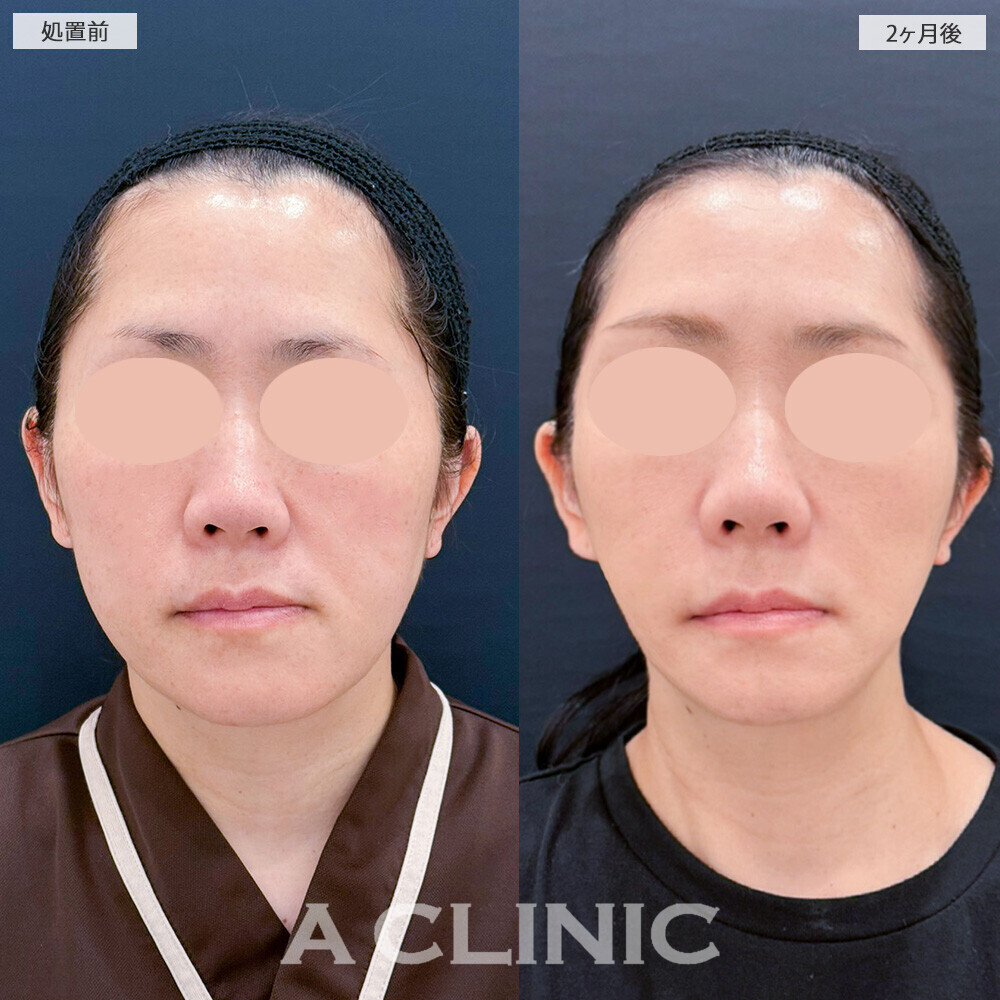 A式美肌たるみ切開でフェイスラインのたるみが改善！こちら処置前から2ヶ月後の症例です(40代女性)