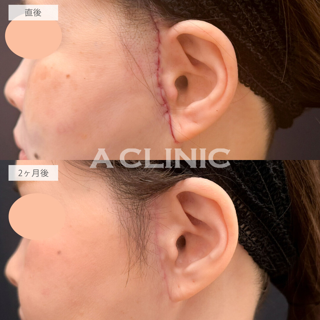 【直後の傷跡あり】A式ナゾラリフトでたるみを解消しつつ引きあげすぎずに自然で上品な印象に！こちら処置前と2ヶ月後の症例です(50代女性)