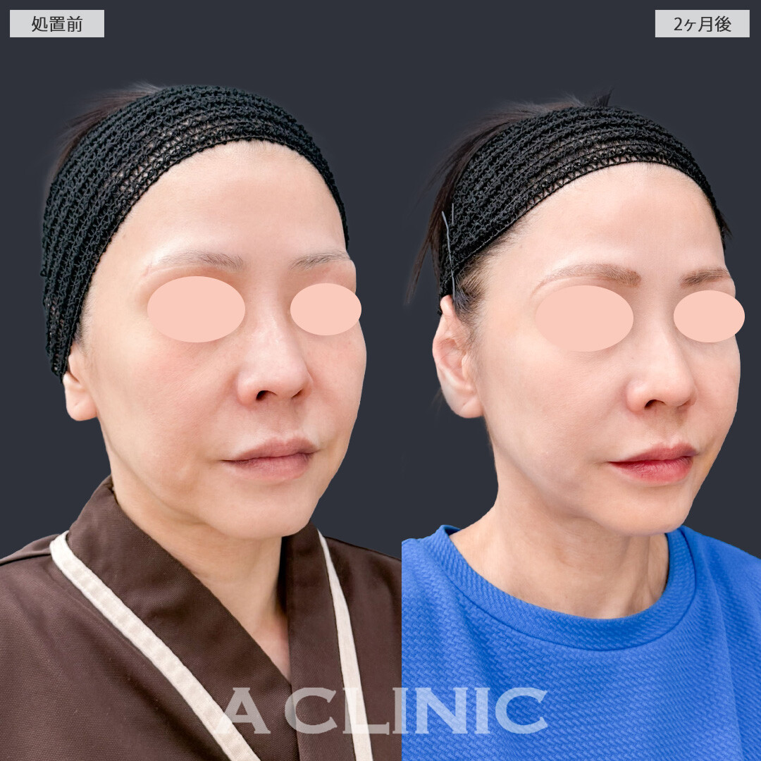 【直後の傷跡あり】A式美肌たるみ切開は1回の施術で高い若返り効果を実感できます！こちら処置前と2ヶ月後の症例です(50代女性)