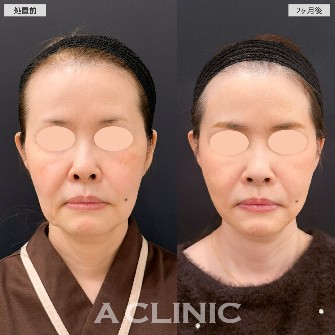 【直後の傷跡あり】A式ナゾラリフトでたるみを解消しつつ引きあげすぎずに自然で上品な印象に！こちら処置前と2ヶ月後の症例です(50代女性)