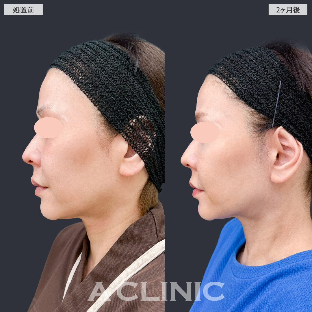【直後の傷跡あり】A式美肌たるみ切開は1回の施術で高い若返り効果を実感できます！こちら処置前と2ヶ月後の症例です(50代女性)