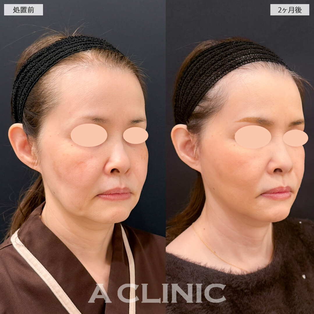 【直後の傷跡あり】A式ナゾラリフトでたるみを解消しつつ引きあげすぎずに自然で上品な印象に！こちら処置前と2ヶ月後の症例です(50代女性)