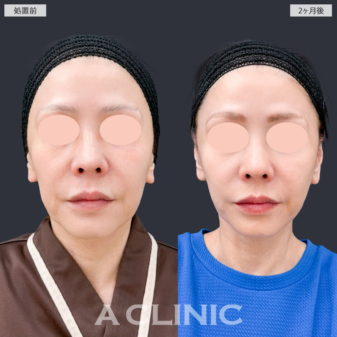 【直後の傷跡あり】A式美肌たるみ切開は1回の施術で高い若返り効果を実感できます！こちら処置前と2ヶ月後の症例です(50代女性)