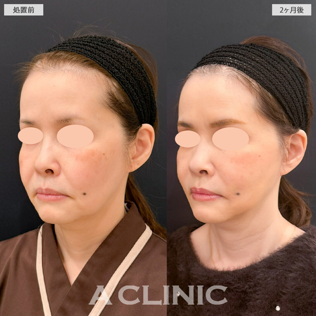 【直後の傷跡あり】A式ナゾラリフトでたるみを解消しつつ引きあげすぎずに自然で上品な印象に！こちら処置前と2ヶ月後の症例です(50代女性)