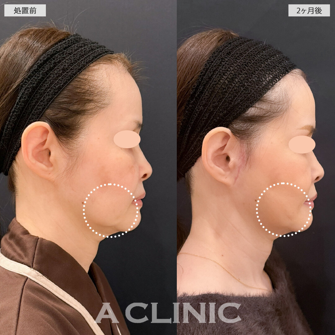 【直後の傷跡あり】A式ナゾラリフトでたるみを解消しつつ引きあげすぎずに自然で上品な印象に！こちら処置前と2ヶ月後の症例です(50代女性)