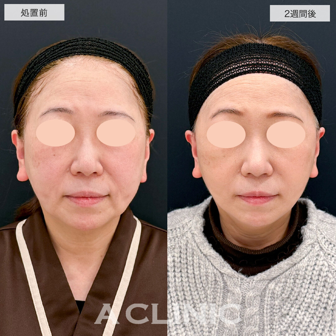 【直後の傷跡あり】A式美肌たるみ切開で悩みだったマリオネットラインが解消しました!こちら処置前と2週間後の症例です(60代女性)