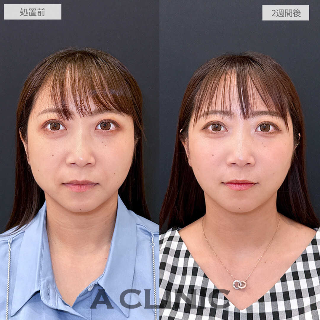 【直後の傷跡あり】A式美肌たるみ切開とヒアルロン酸注射(シワ)でほうれい線とたるみを一度で改善！こちら処置前と2週間後の症例です(30代女性)