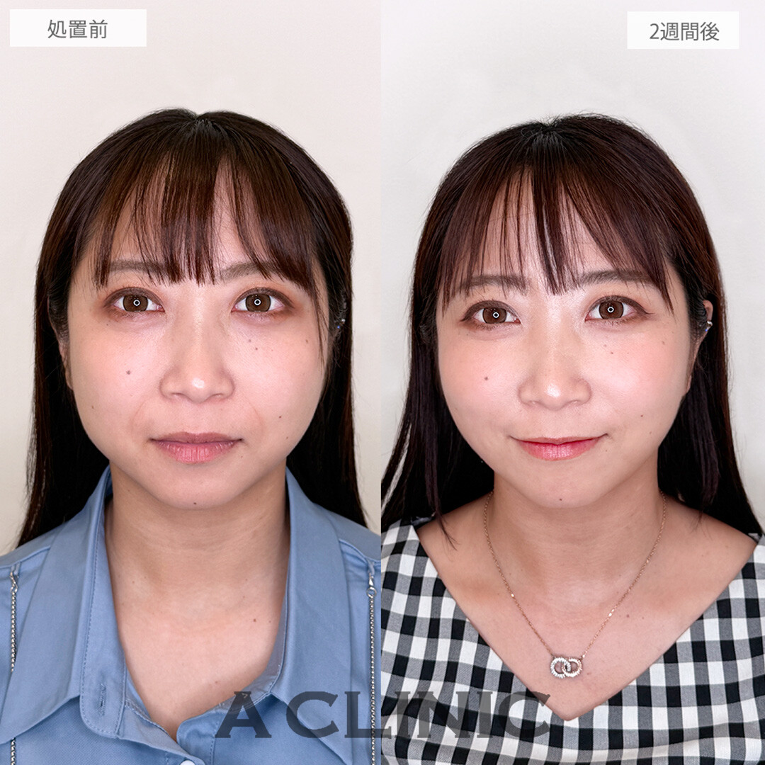 【直後の傷跡あり】A式美肌たるみ切開とヒアルロン酸注射(シワ)でほうれい線とたるみを一度で改善！こちら処置前と2週間後の症例です(30代女性)