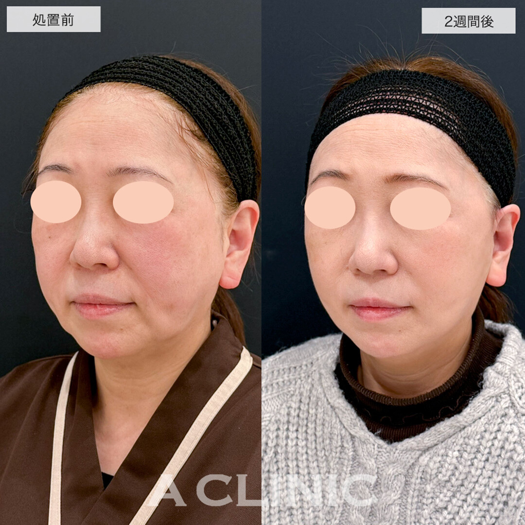 【直後の傷跡あり】A式美肌たるみ切開で悩みだったマリオネットラインが解消しました!こちら処置前と2週間後の症例です(60代女性)