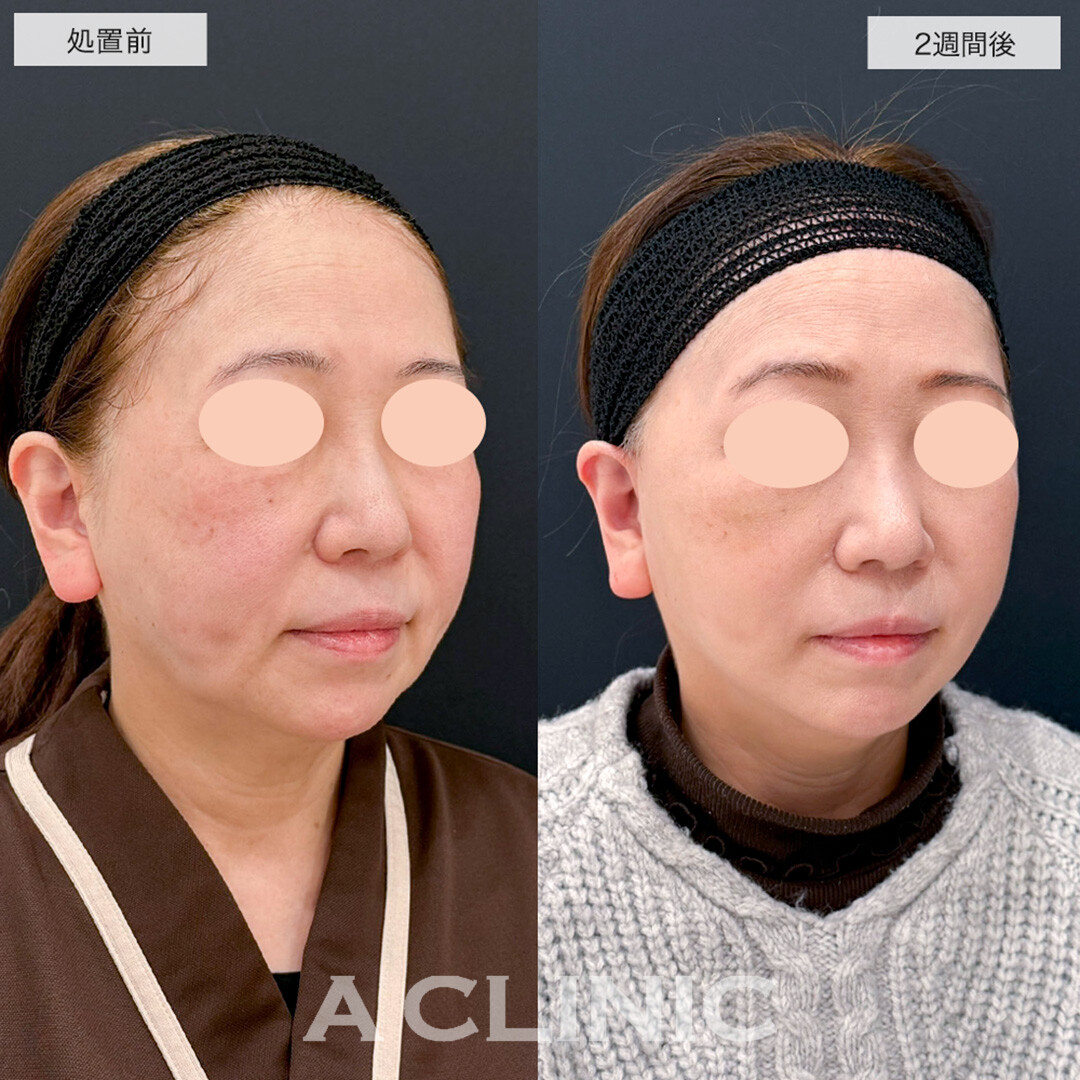 【直後の傷跡あり】A式美肌たるみ切開で悩みだったマリオネットラインが解消しました!こちら処置前と2週間後の症例です(60代女性)