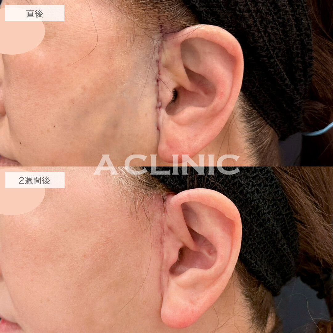 【直後の傷跡あり】A式美肌たるみ切開で悩みだったマリオネットラインが解消しました!こちら処置前と2週間後の症例です(60代女性)