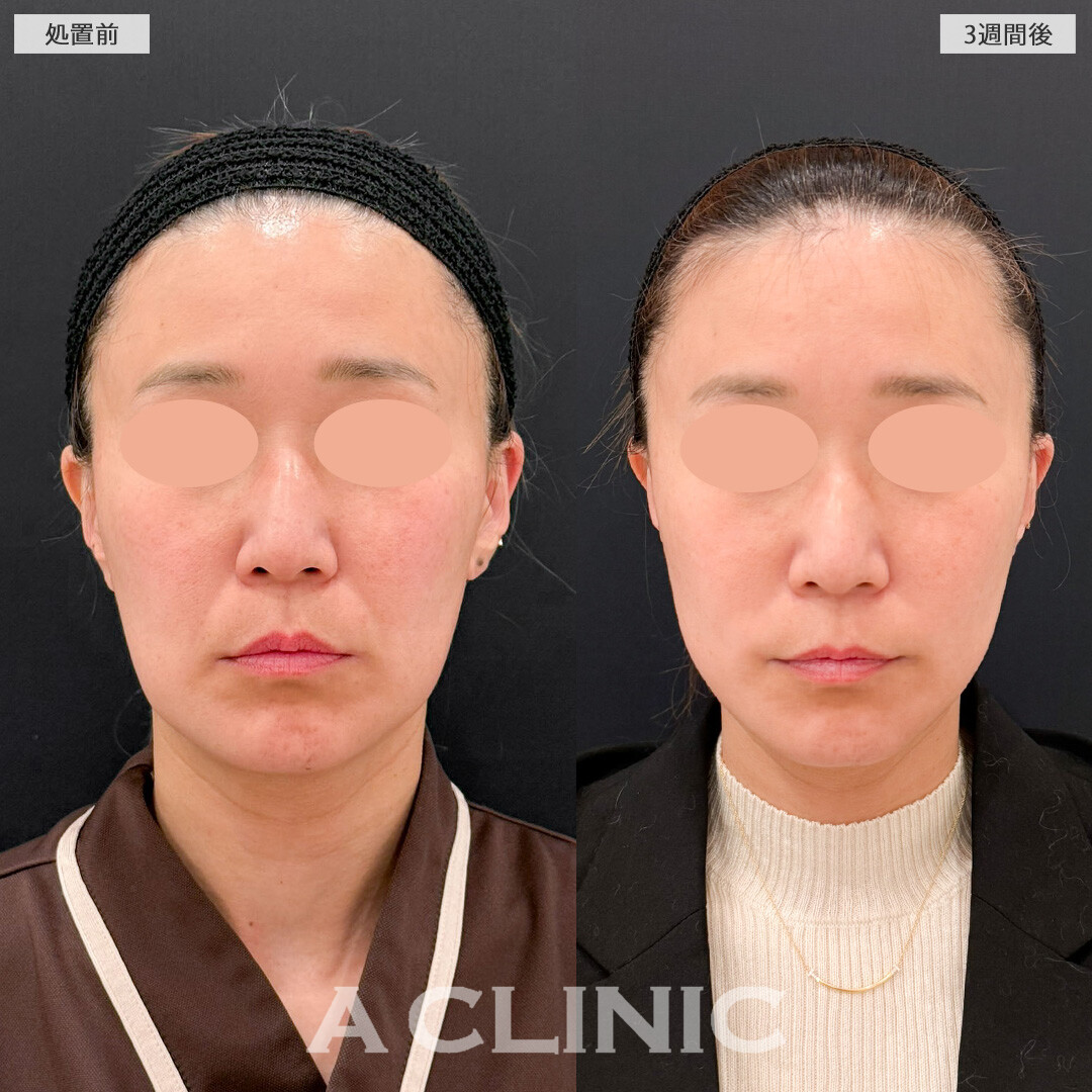 【直後の傷跡あり】A式美肌たるみ切開で糸リフトでは解決できなかったたるみ感を徹底除去できます！こちら処置前と3週間後の症例です(40代女性)