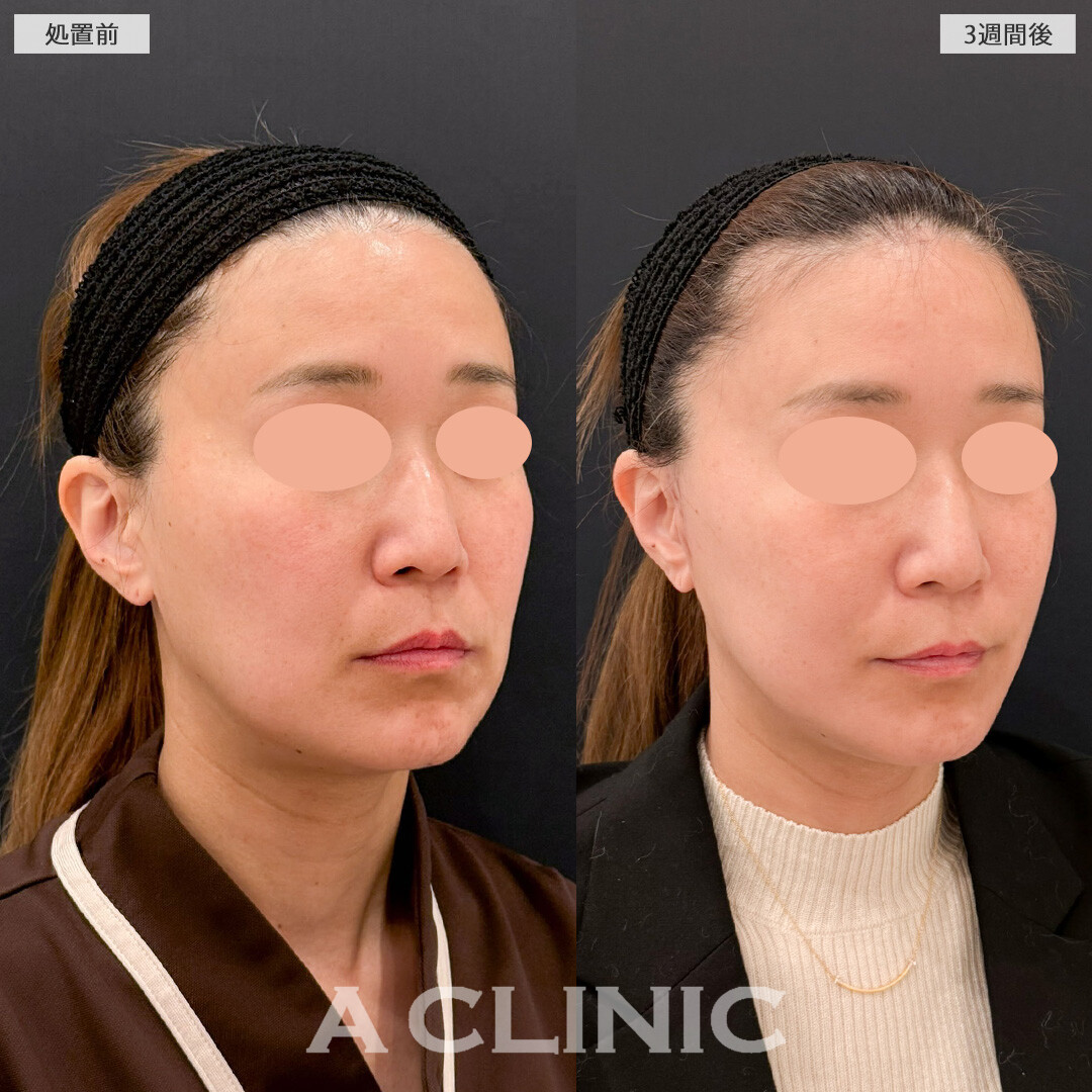 【直後の傷跡あり】A式美肌たるみ切開で糸リフトでは解決できなかったたるみ感を徹底除去できます！こちら処置前と3週間後の症例です(40代女性)