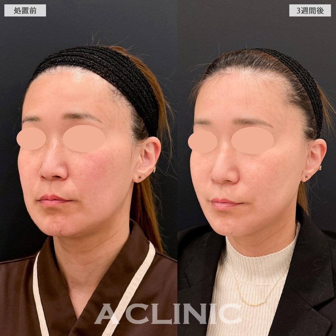 【直後の傷跡あり】A式美肌たるみ切開で糸リフトでは解決できなかったたるみ感を徹底除去できます！こちら処置前と3週間後の症例です(40代女性)