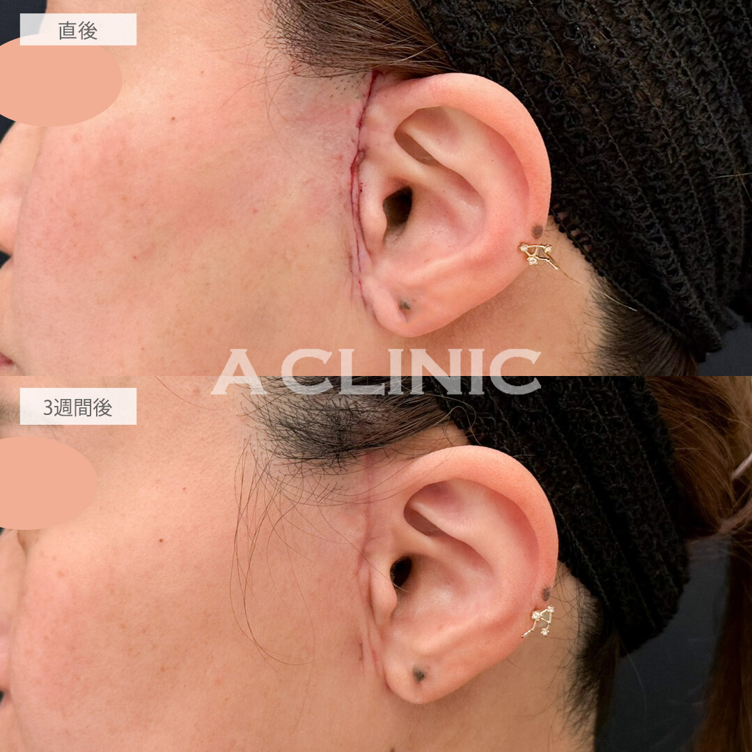 【直後の傷跡あり】A式美肌たるみ切開で糸リフトでは解決できなかったたるみ感を徹底除去できます！こちら処置前と3週間後の症例です(40代女性)