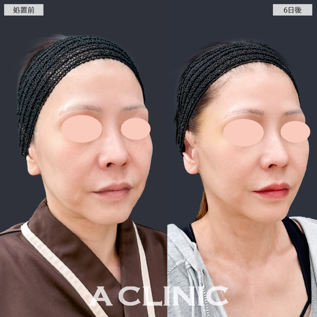 【直後の傷跡あり】A式美肌たるみ切開はダウンタイム短くたるみの根本治療ができます！こちら処置前と6日後の症例です(50代女性)