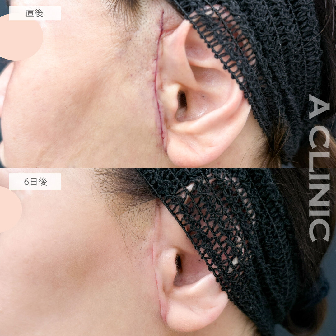 【直後の傷跡あり】A式美肌たるみ切開はダウンタイム短くたるみの根本治療ができます！こちら処置前と6日後の症例です(50代女性)