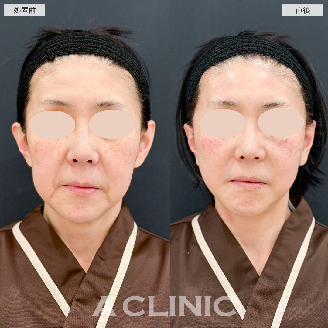 【直後の傷跡あり】A式美肌たるみ切開で直後から若返った印象に！処置前と直後の症例です(50代女性)