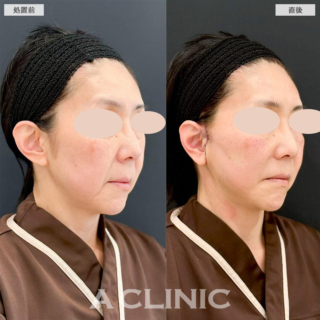 【直後の傷跡あり】A式美肌たるみ切開で直後から若返った印象に！処置前と直後の症例です(50代女性)