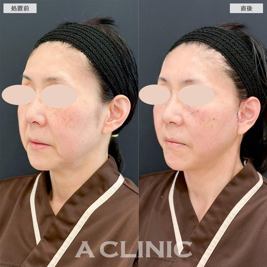 【直後の傷跡あり】A式美肌たるみ切開で直後から若返った印象に！処置前と直後の症例です(50代女性)
