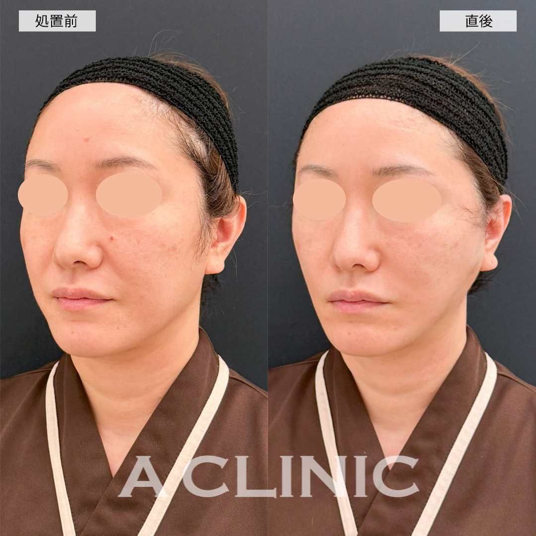 【直後の傷跡あり】A式美肌たるみ切開で直後からお悩みだったシワが改善されました！こちら処置前と直後の症例です(40代女性)