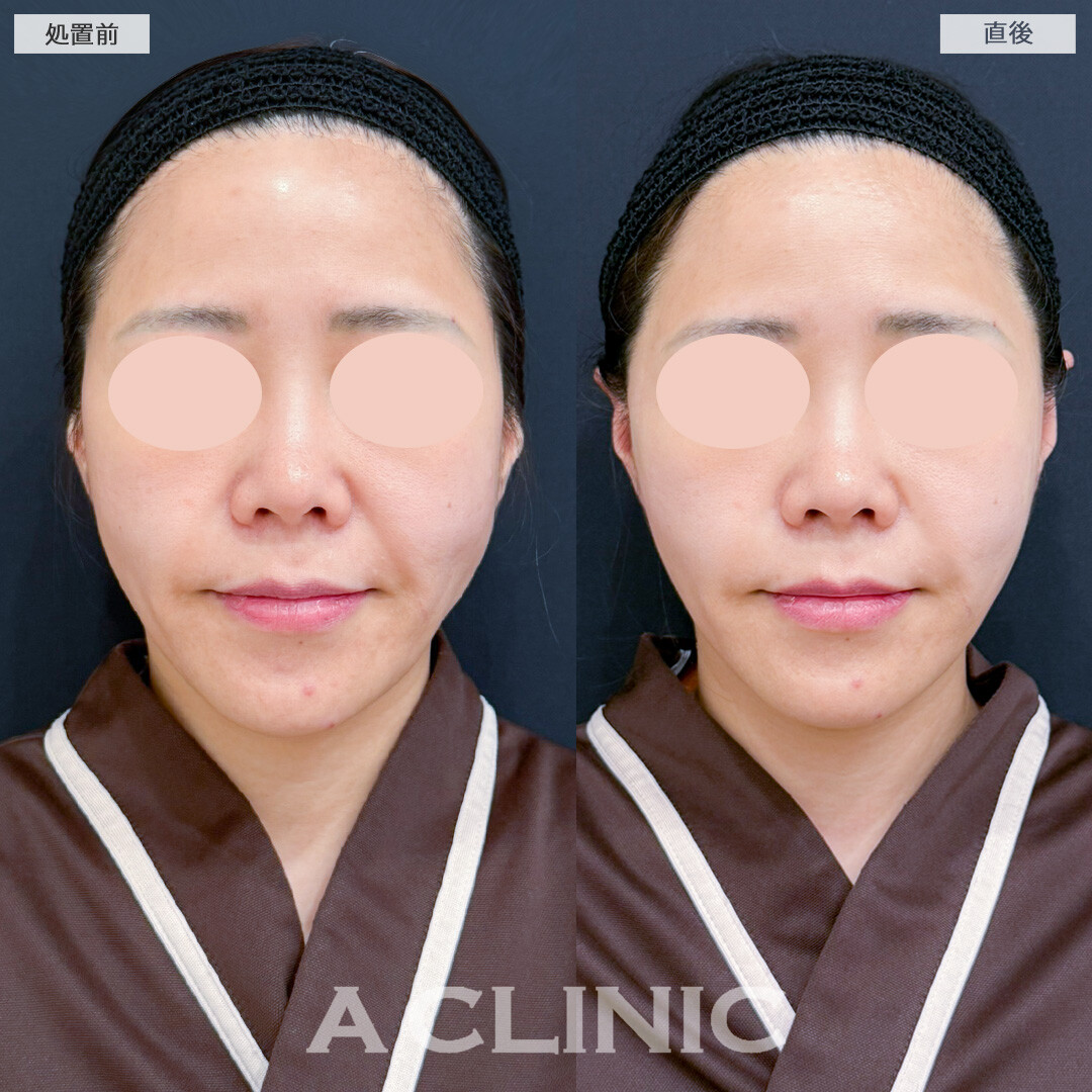 【直後の傷跡あり】A式美肌たるみ切開で直後からたるみの目立たないシュッとした輪郭に！処置前と直後の症例です(30代女性)