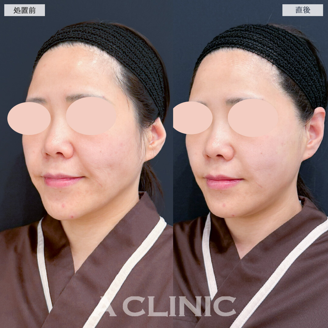 【直後の傷跡あり】A式美肌たるみ切開で直後からたるみの目立たないシュッとした輪郭に！処置前と直後の症例です(30代女性)