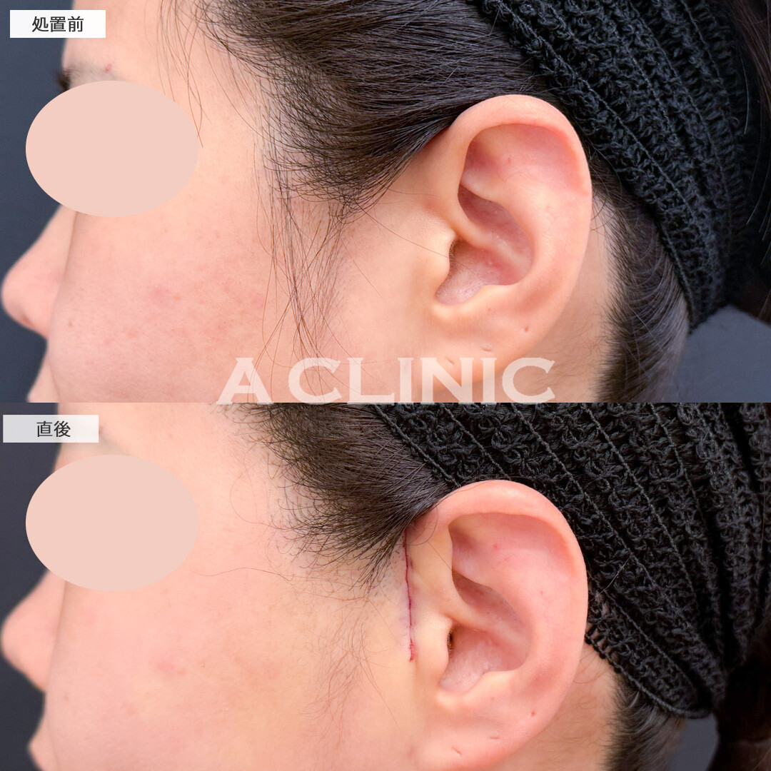 【直後の傷跡あり】A式美肌たるみ切開で直後からたるみの目立たないシュッとした輪郭に！処置前と直後の症例です(30代女性)