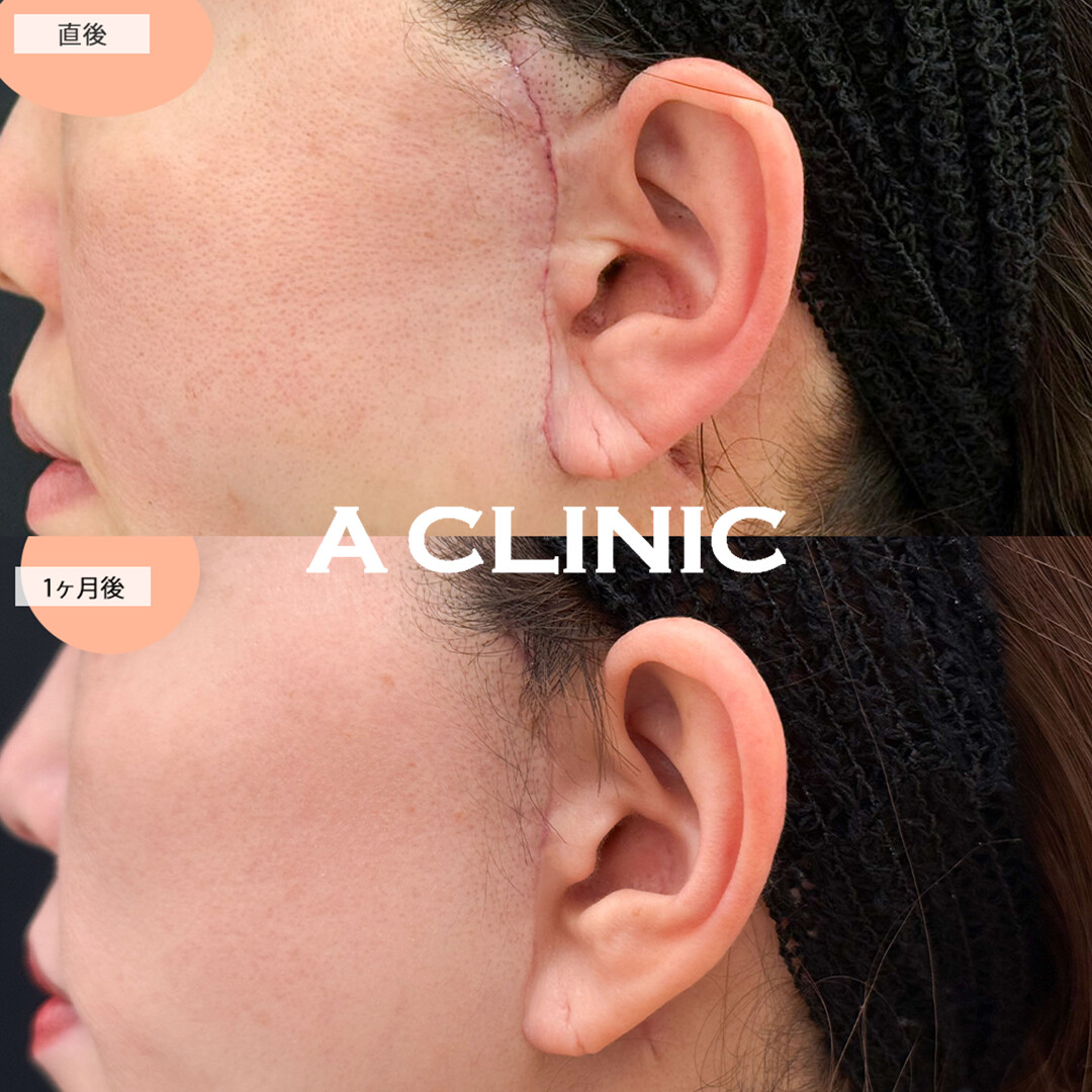 【直後の傷跡あり】A式美肌たるみ切開でフェイスラインのもたつきが改善され若返り！こちら処置前から1ヶ月後の症例です(40代女性)