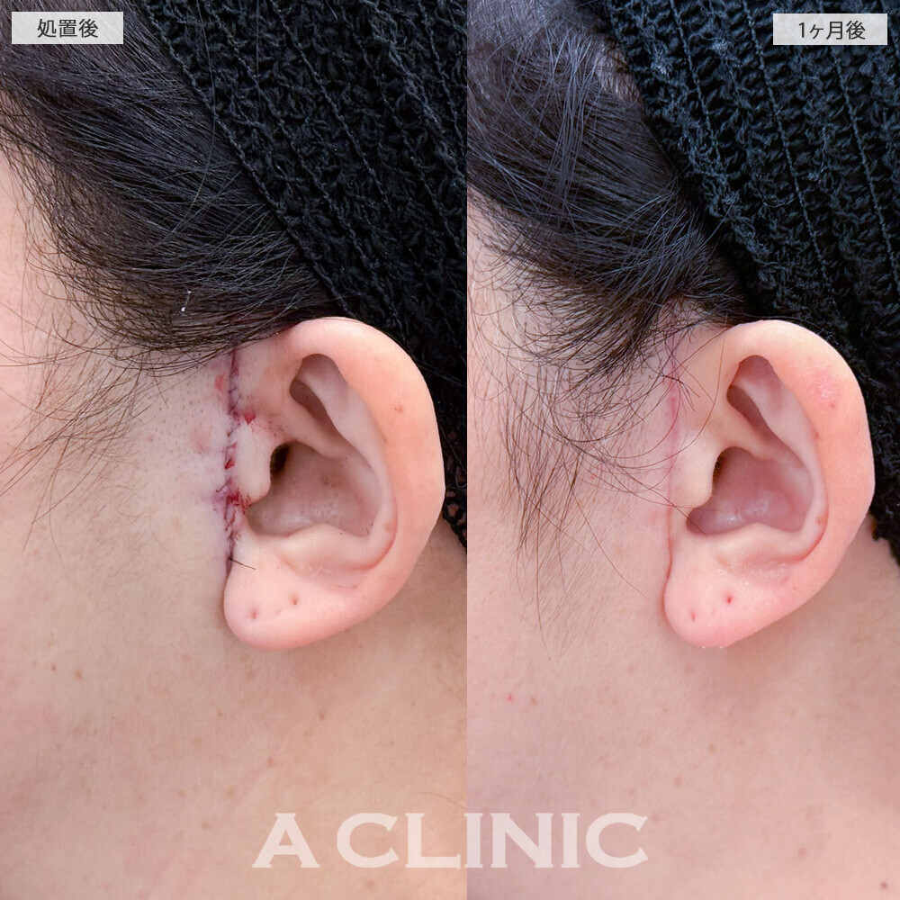 A式美肌たるみ切開でフェイスラインのたるみが改善！こちら処置前から2ヶ月後の症例です(40代女性)