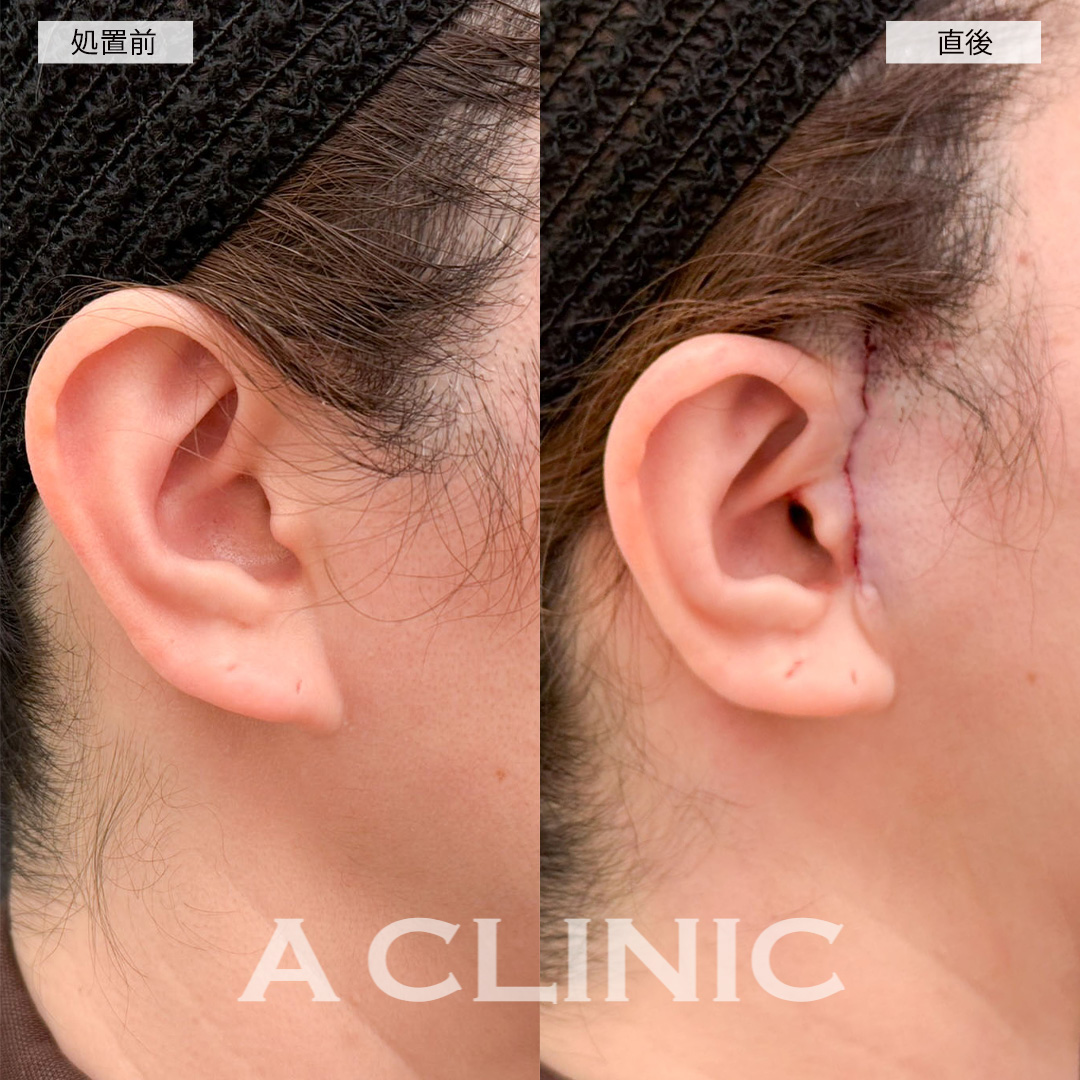 【直後の傷跡あり】A式美肌たるみ切開で直後からお悩みだったシワが改善されました！こちら処置前と直後の症例です(40代女性)