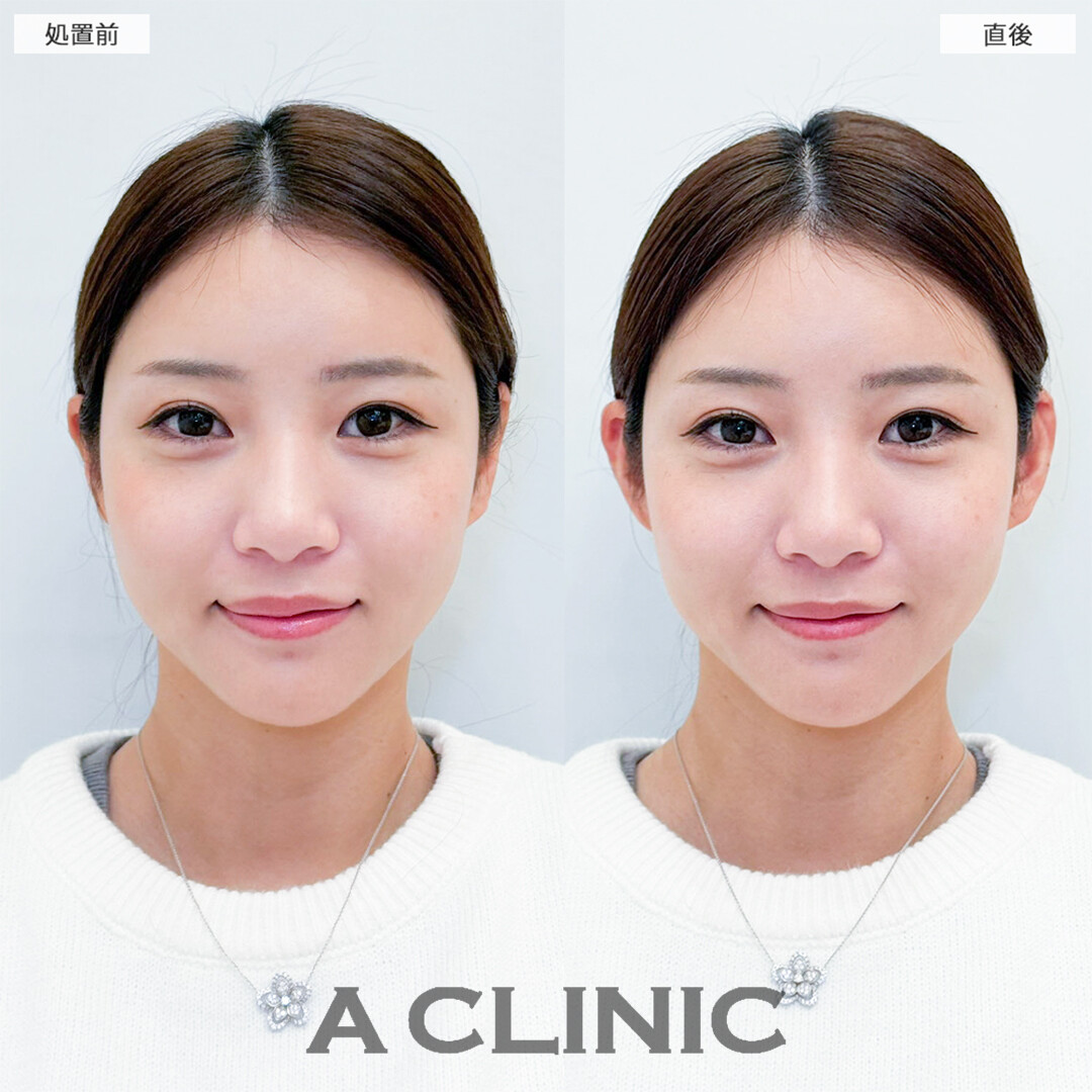 立ち耳ヒアルロン酸注入(ボリューマ)で中顔面も短く見えて可愛さ倍増！こちら処置前と直後の症例です(20代女性)