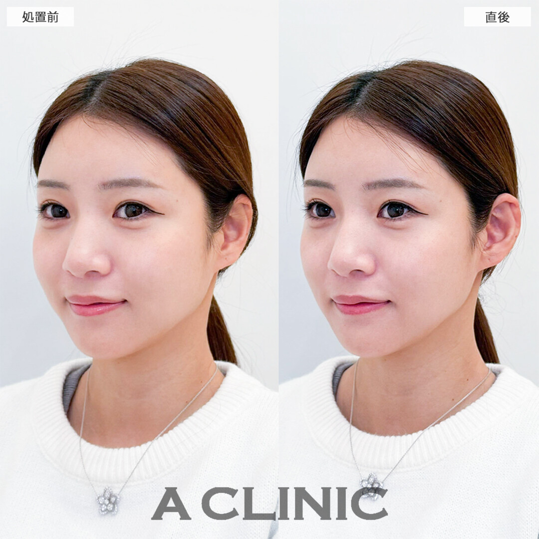 立ち耳ヒアルロン酸注入(ボリューマ)で中顔面も短く見えて可愛さ倍増！こちら処置前と直後の症例です(20代女性)