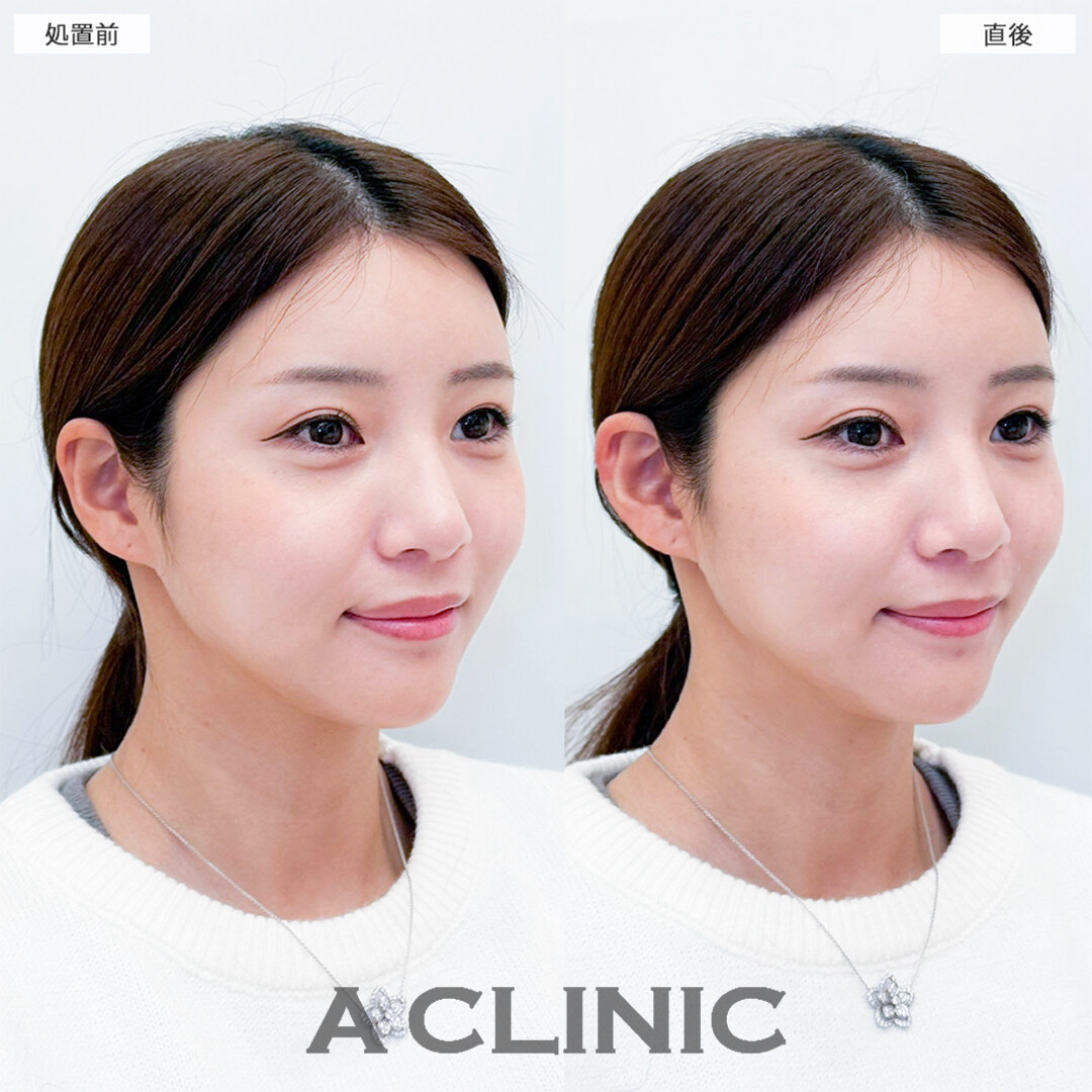 立ち耳ヒアルロン酸注入(ボリューマ)で中顔面も短く見えて可愛さ倍増！こちら処置前と直後の症例です(20代女性)