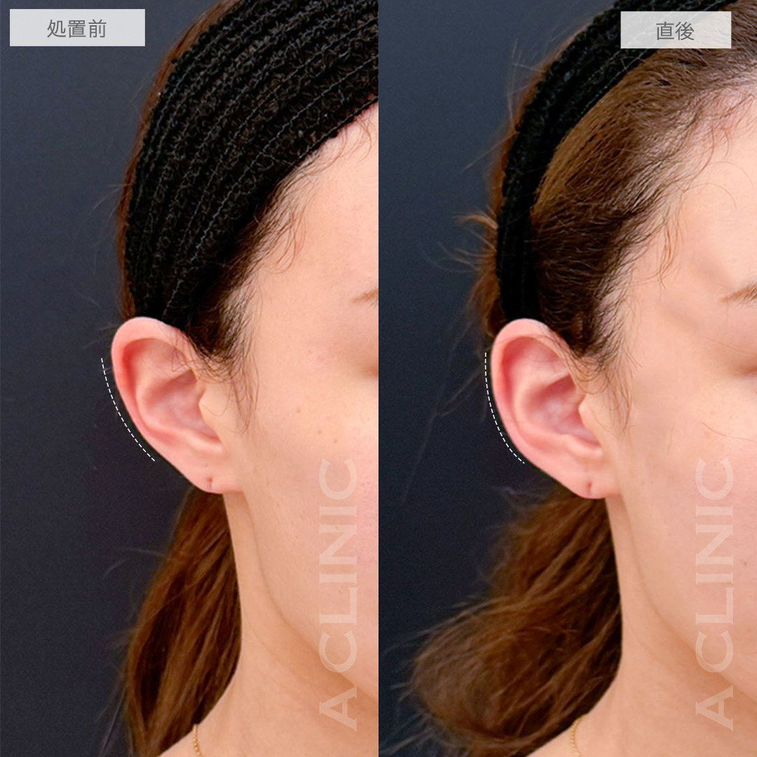 立ち耳ヒアルロン酸注入(ボリューマ)は中顔面短縮効果もあります！こちら処置前と直後の症例です(20代女性)