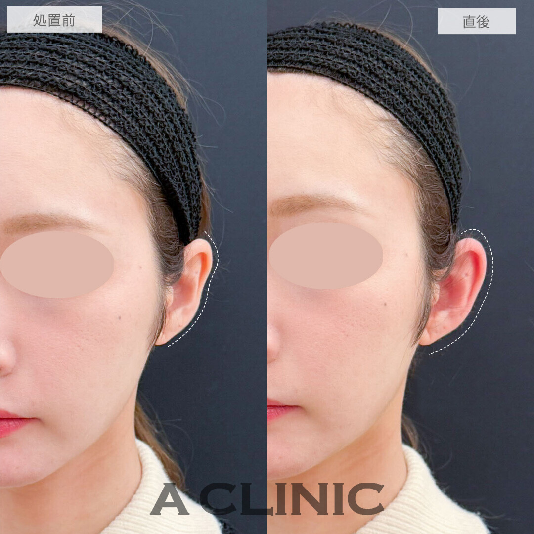 立ち耳ヒアルロン酸注入(ボリューマ)は短時間で小顔効果あり！こちら処置前と直後の症例です(20代女性)