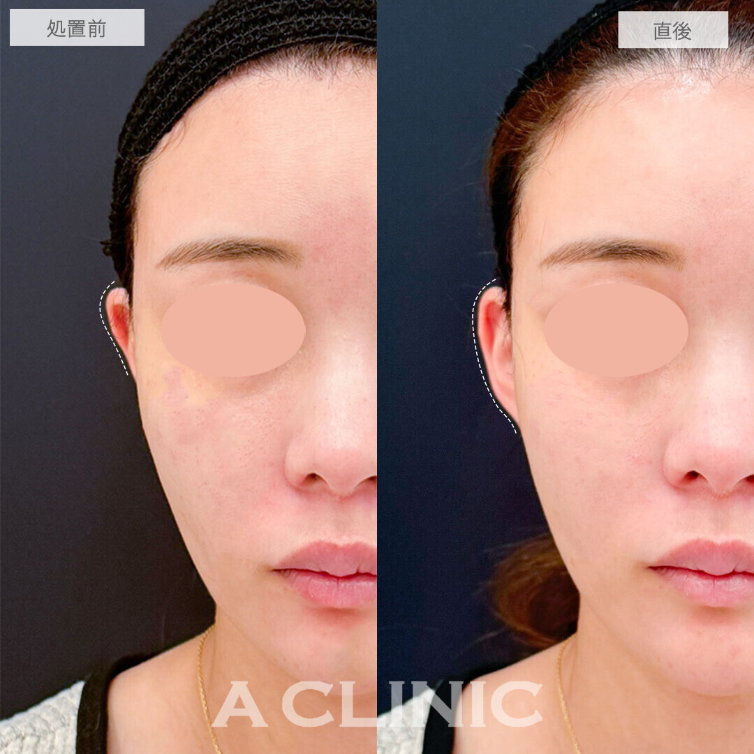 立ち耳ヒアルロン酸注入(ボリューマ)は中顔面短縮効果もあります！こちら処置前と直後の症例です(20代女性)