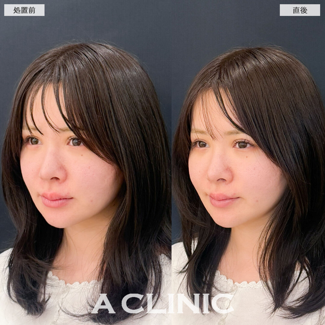 XERF(ザーフ)で痛み少なくたるみをしっかり引き上げました！こちら処置前と直後の症例です(30代女性)